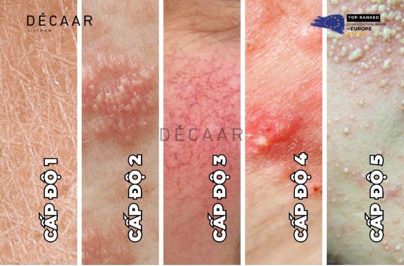 các cấp độ da nhiễm corticoid